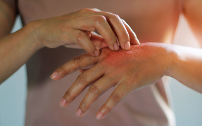 Qué es la dermatitis y cómo tratarla